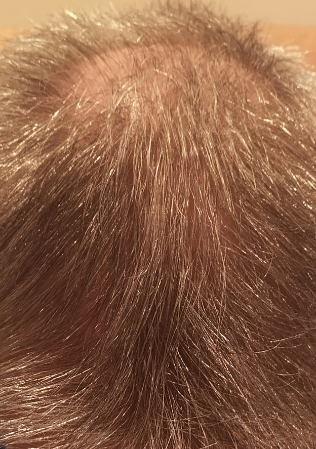 After - Dermot