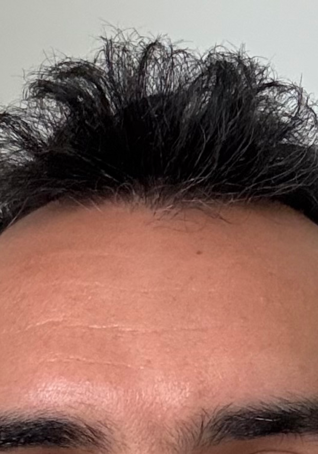 Before - Enis