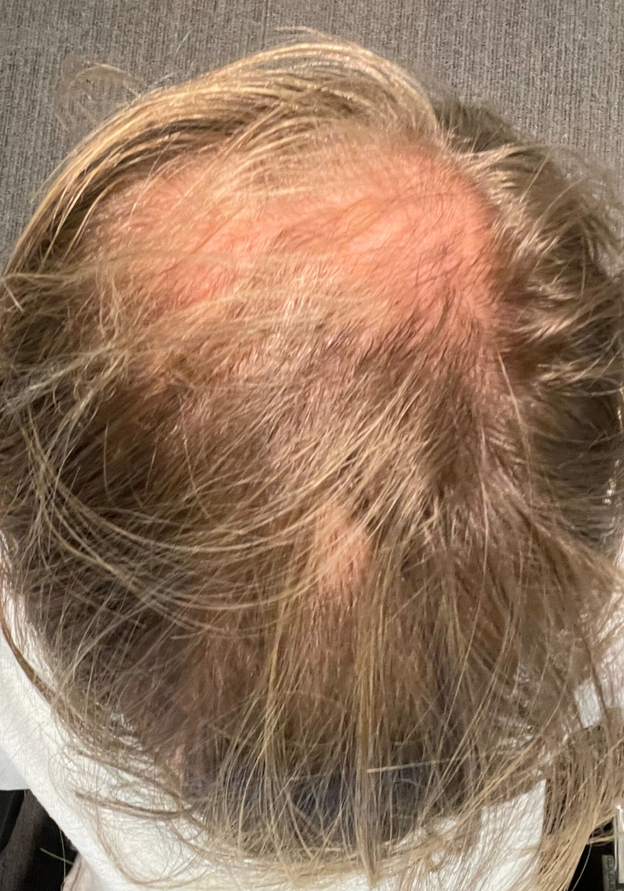 Before - Pepijn