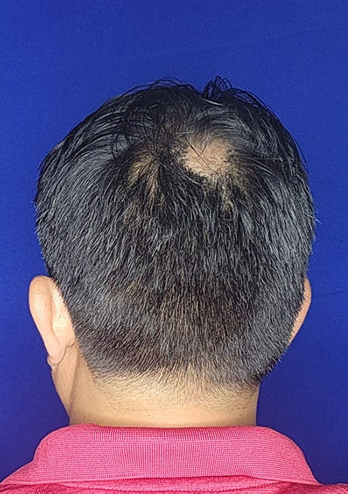 Before - Lorenzo