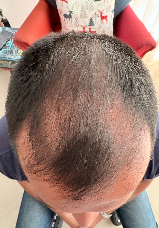 Before - Giancarlo